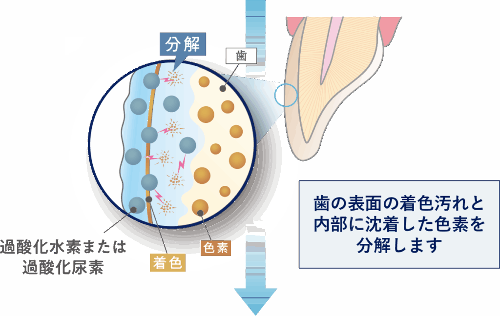 医療ホワイトニングは、歯の表面の着色汚れと内部に沈着した色素を分解