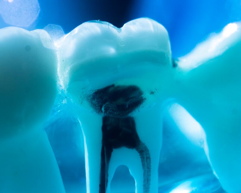 虫歯