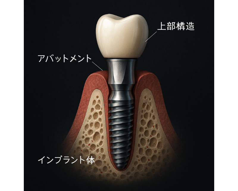 インプラントの構造