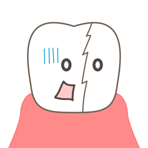 歯に入ったクラック（ヒビ）