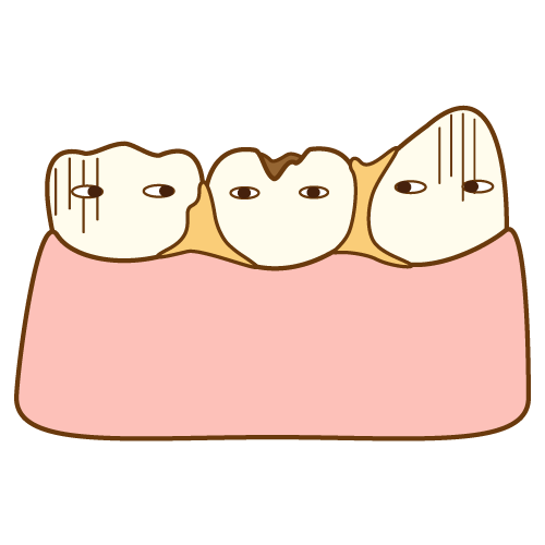 かみ合わせがずれる