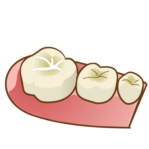 シーラント