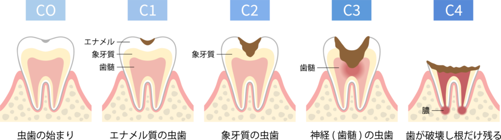 虫歯の進行