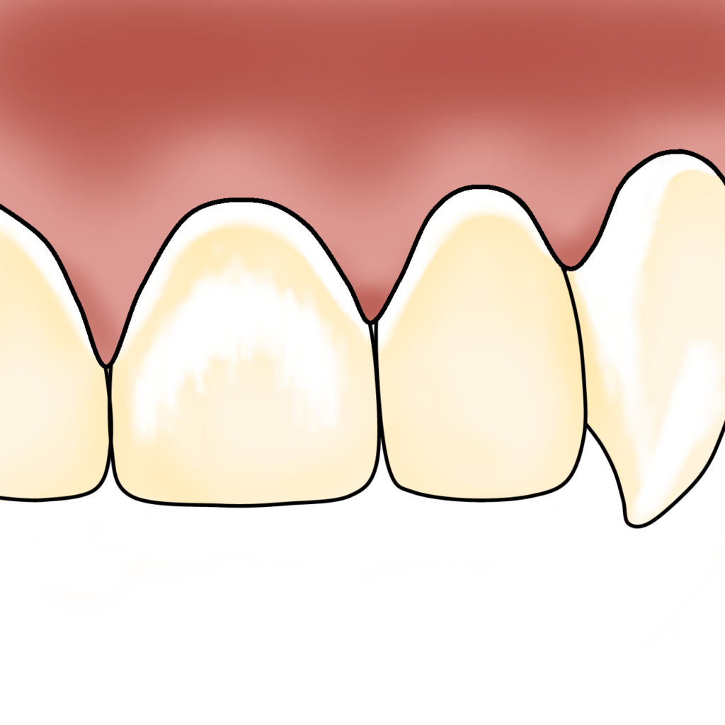ホワイトスポット