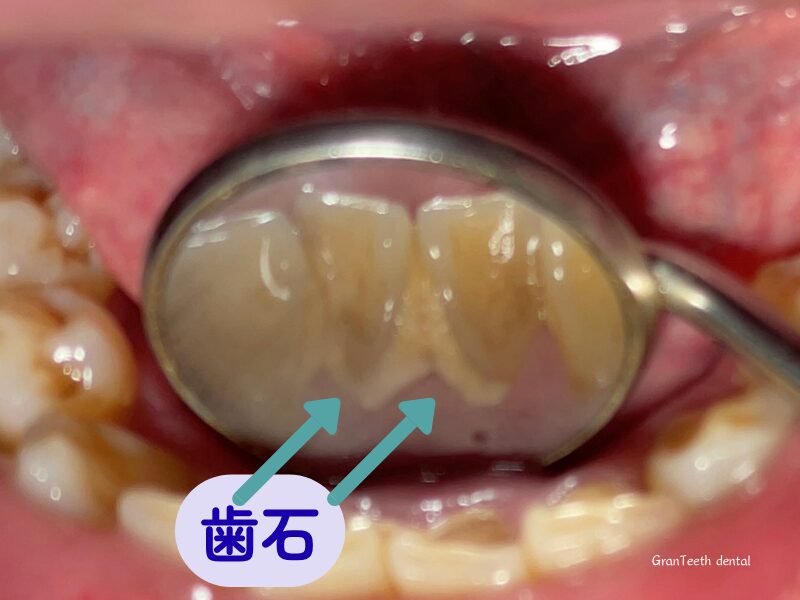 歯石が付着した歯の拡大写真