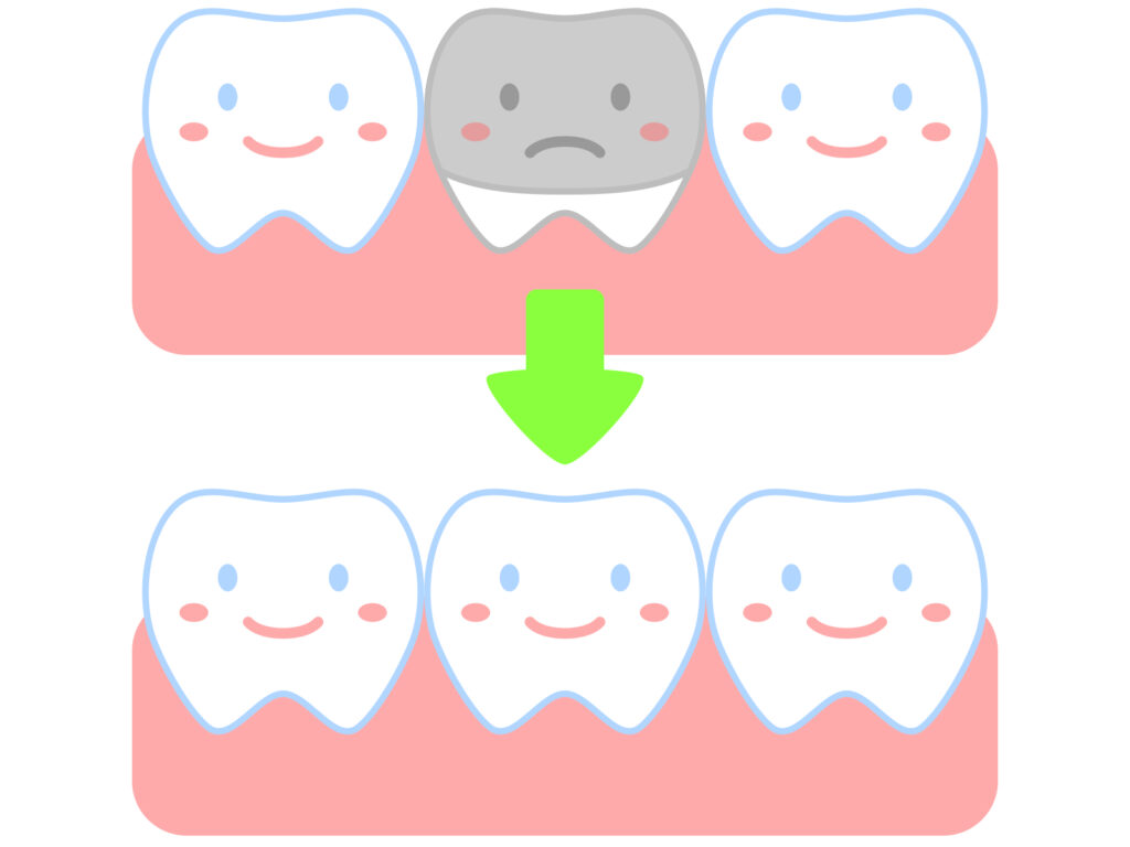 メタルフリー治療の図