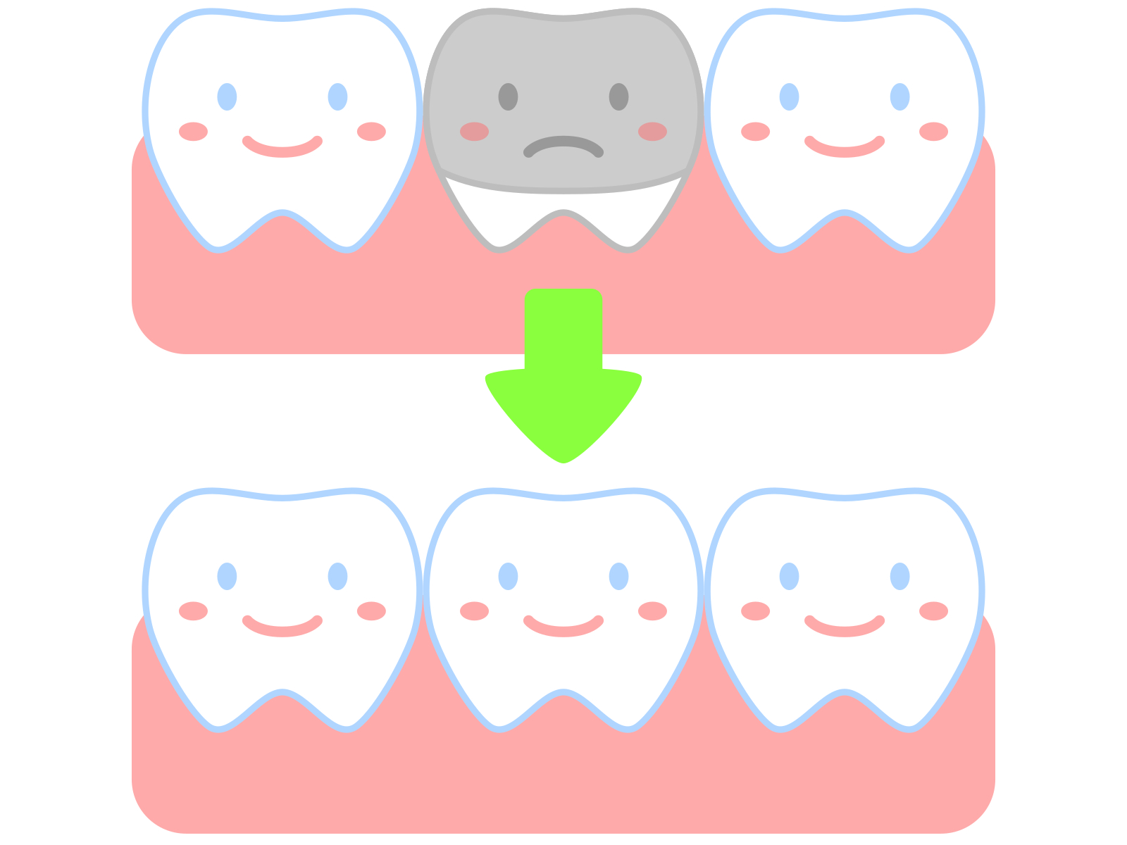 メタルフリー治療の図