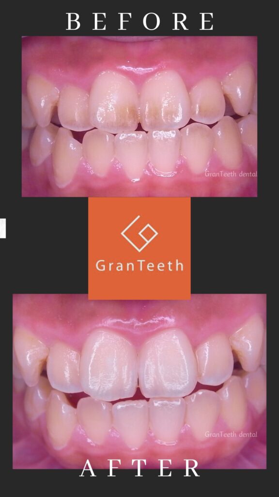 武蔵小山の歯医者グランティース武蔵小山歯科の予防歯科・PMTCによる歯のステイン除去ビフォーアフター症例写真