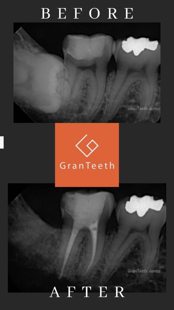 武蔵小山の歯医者グランティース武蔵小山歯科の精密根管治療ビフォーアフター。マイクロスコープを使った根管治療の症例写真