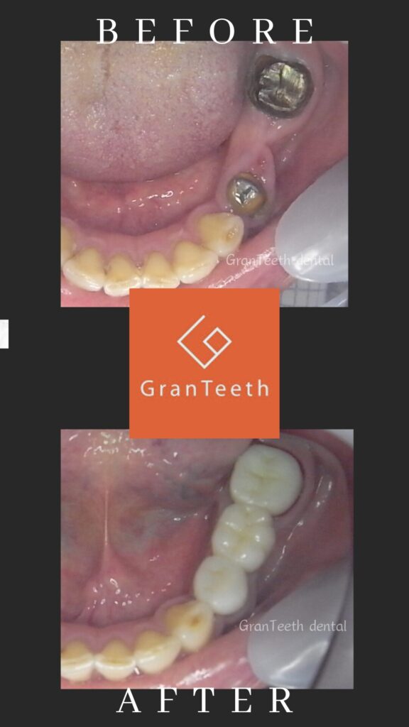 武蔵小山の歯医者グランティース武蔵小山歯科のジルコニア修復ビフォーアフター。歯がない状態から自然な見た目を回復した症例写真