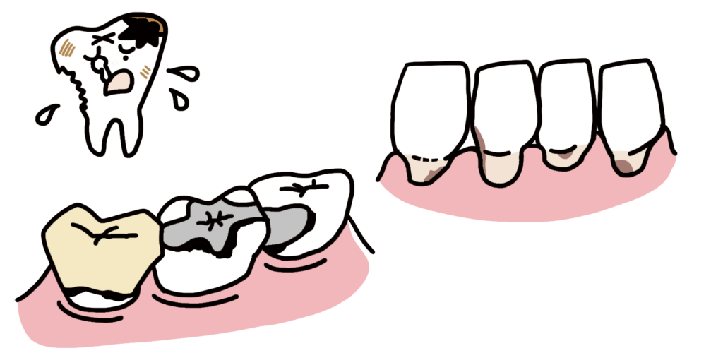 ２次カリエス