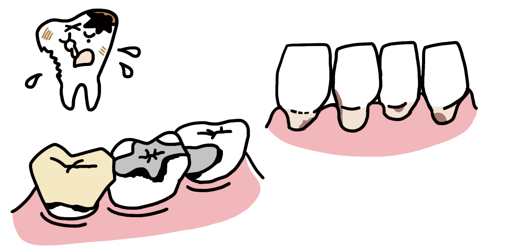 ２次カリエス